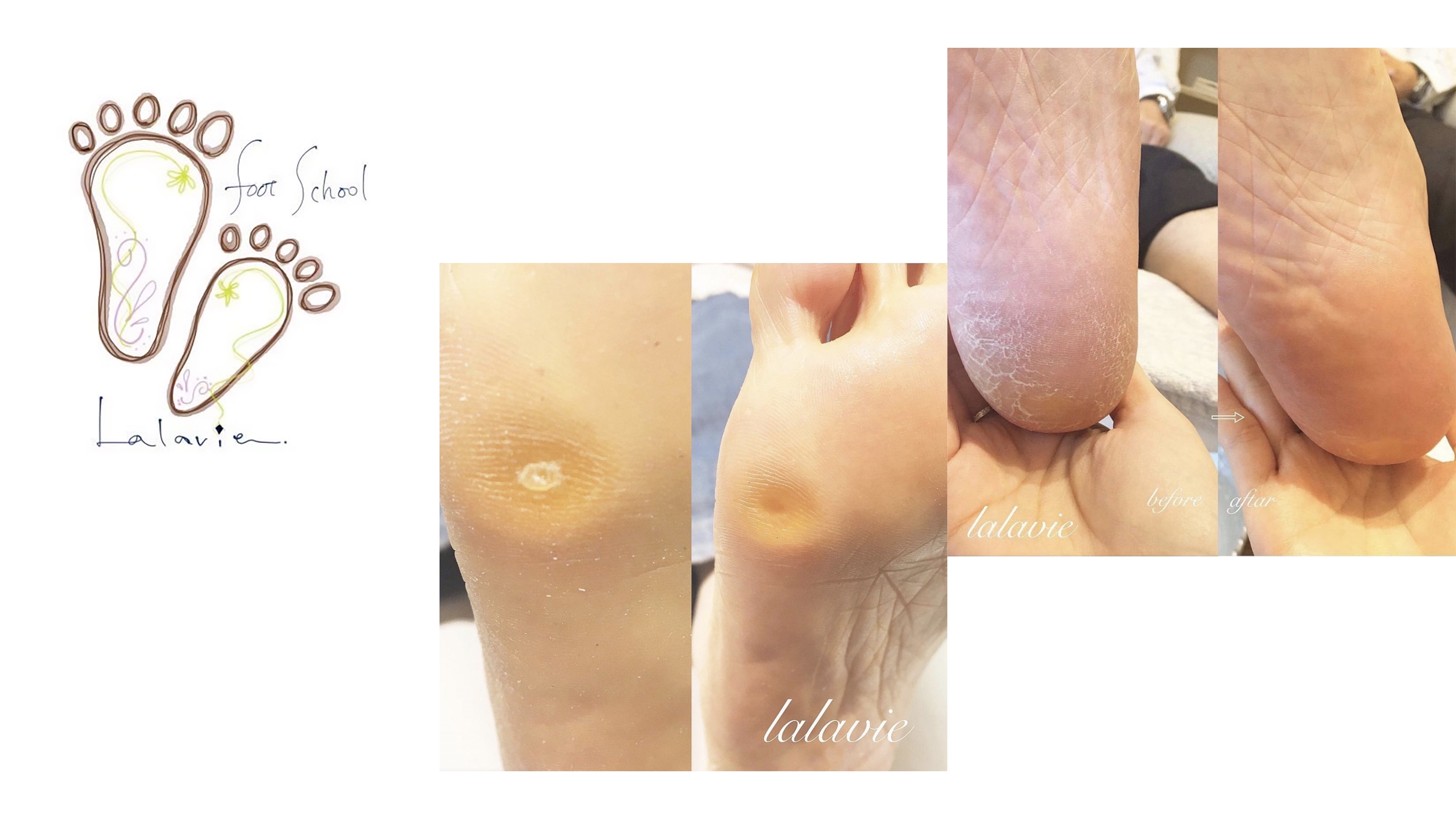 スクールメニュー | 札幌 巻き爪 フットケアスクール comodo cure札幌