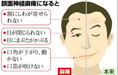 人生初の顔面神経麻痺 島津建築設計事務所