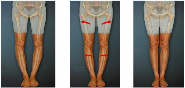 O脚x脚矯正 湘南健康カイロはダイエットと骨盤の専門院