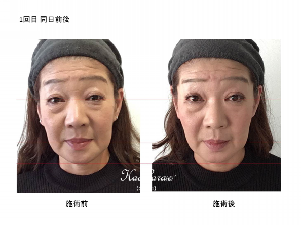 比較写真 Kaocara E カオカラ