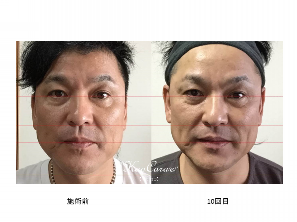比較写真 Kaocara E カオカラ 比較写真 Kaocara E カオカラ