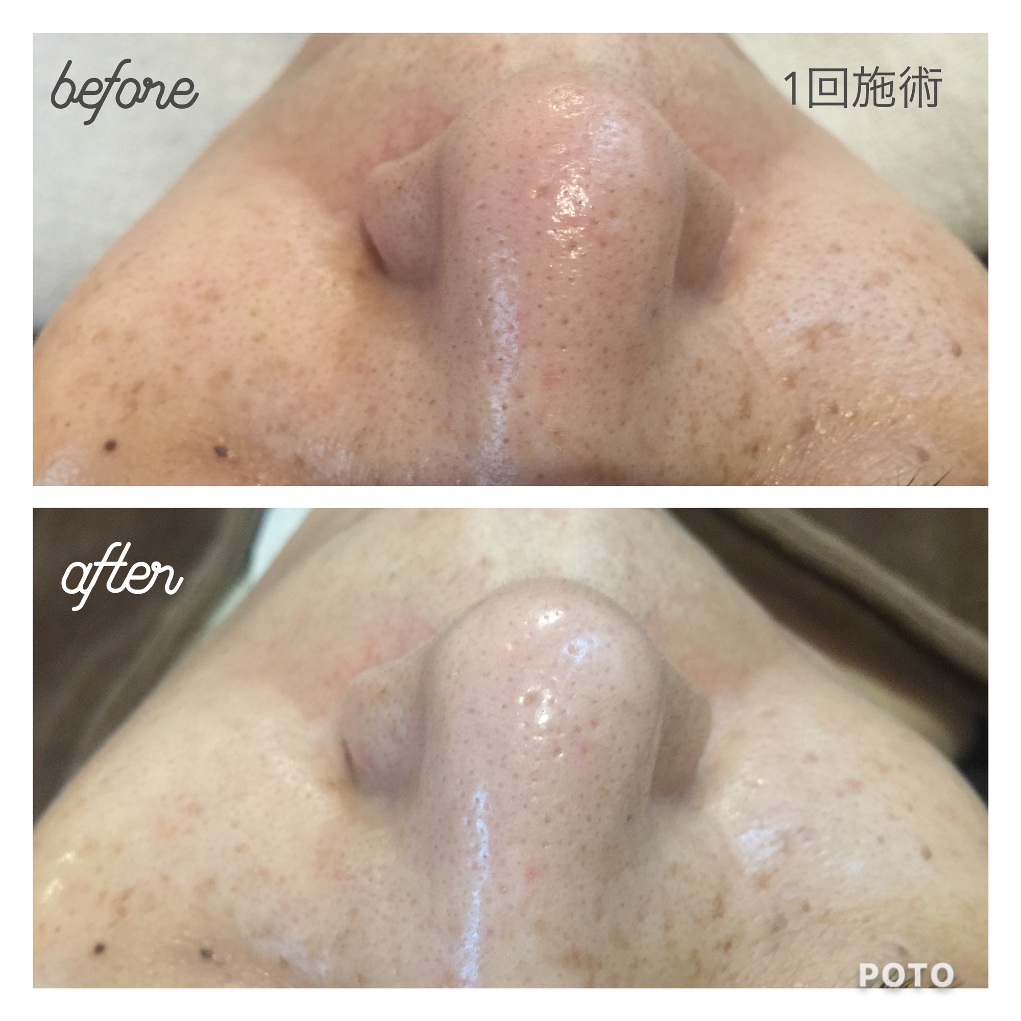 ダーマスクライバ― 美肌 超音波洗浄 毛穴洗浄 顔やせ ポイズニングケア