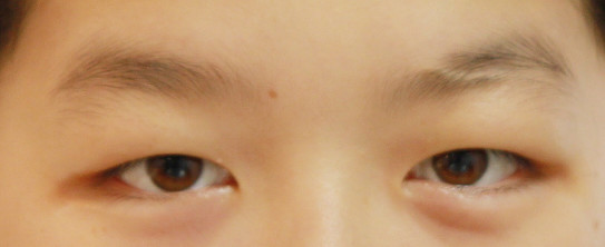 眉毛の中の傷跡をカモフラージュする アヴェニュークリニックの最新アートメイク Nu Make