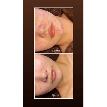 NEW！REVI陶肌ピール誕生】 | 雅菜 miyabina