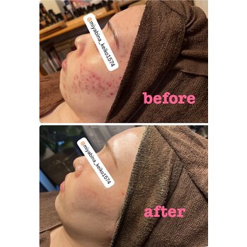 NEW！REVI陶肌ピール誕生】 | 雅菜 miyabina