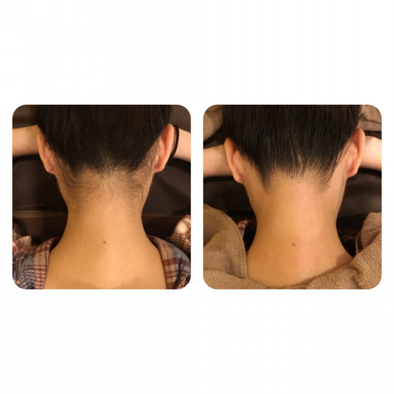 首が長く見えるワックス Wax脱毛 ピュアンリテ 首が長く見えるワックス Wax脱毛 ピュアンリテ