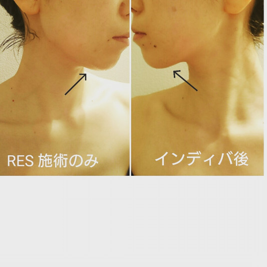 顔セルライト 神戸駅から2分 インディバサロンtesta テスタ