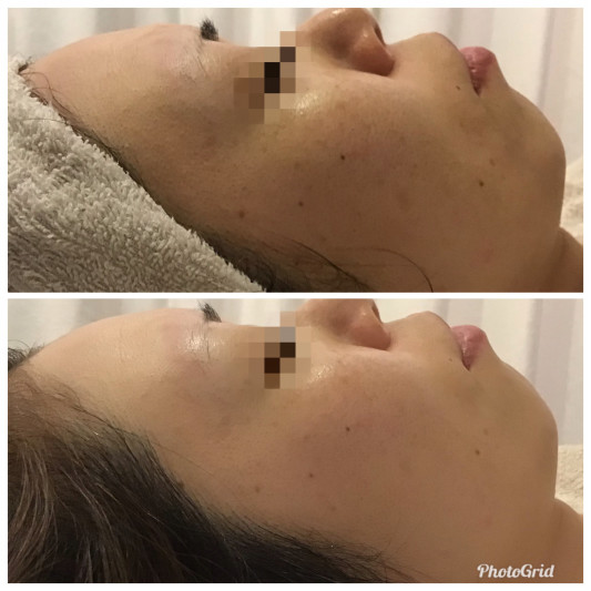 エンビロンのエステ1回でここまで変わる エンビロン正規代理店 Unerencontre ユヌ ランコント