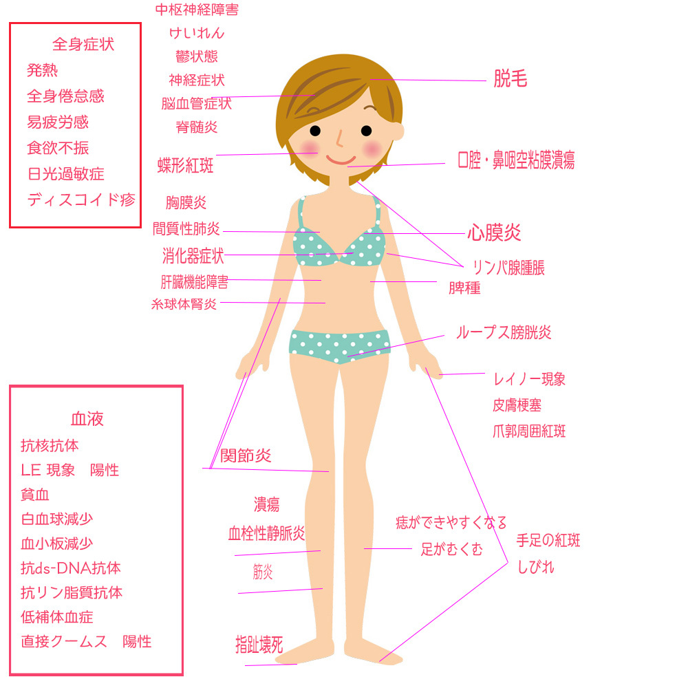 Sleとは うちのsle