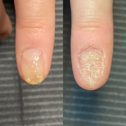 深爪さん 途中経過 Chloe Nail Design 深爪さん 途中経過 Chloe Nail Design