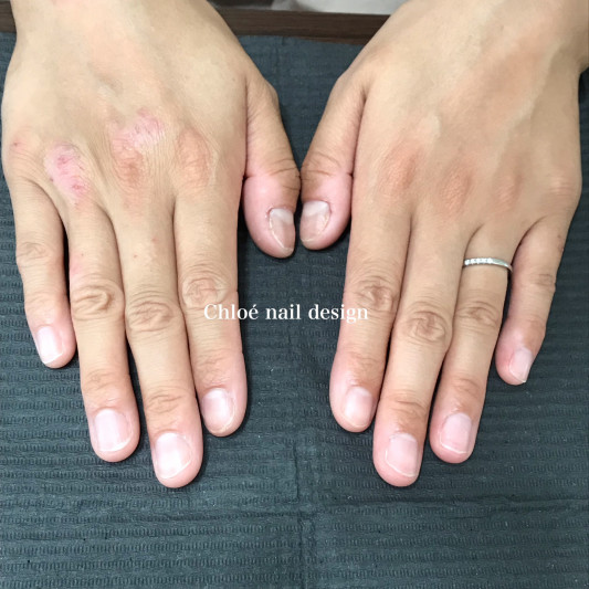深爪ケア1回目 Chloe Nail Design