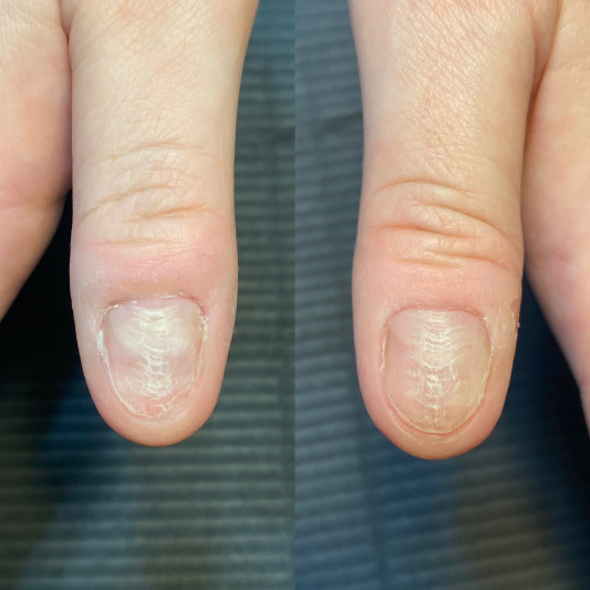 深爪さん 途中経過 Chloe Nail Design 深爪さん 途中経過 Chloe Nail Design