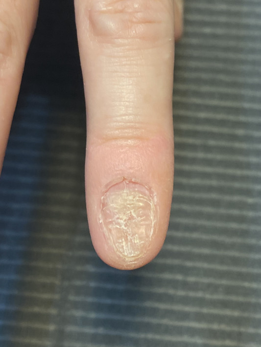 深爪さん 途中経過 Chloe Nail Design 深爪さん 途中経過 Chloe Nail Design
