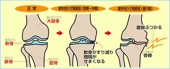 変形性膝関節症 青森市でむちうち治療のなみだて整骨院 手もみ処ほぐしや