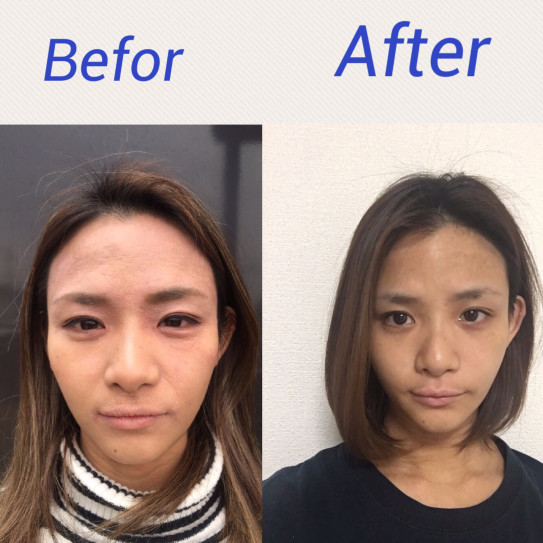 顔中にアトピー発症 自分の身体や心の声を無視し続けた結果 起きた事 ちひろヨガ 顔中にアトピー発症 自分の身体や心の声を無視し続けた結果 起きた事 ちひろヨガ