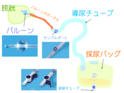 ウロバッグ バルーン 尿カテーテル 膀胱瘻 採尿バッグ Smile