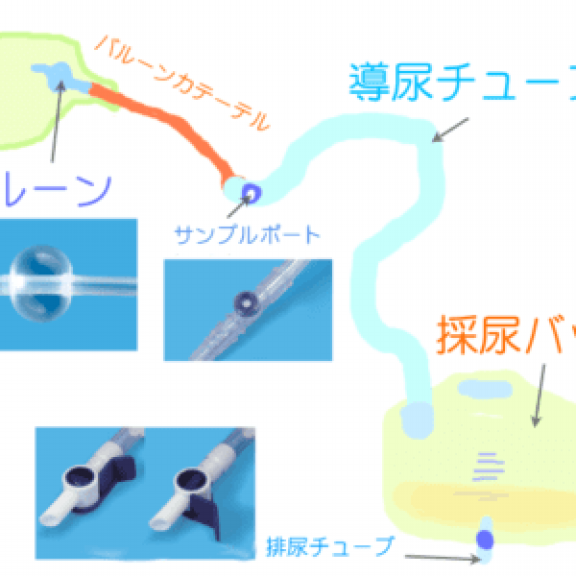 ウロバッグ バルーン 尿カテーテル 膀胱瘻 採尿バッグ Smile