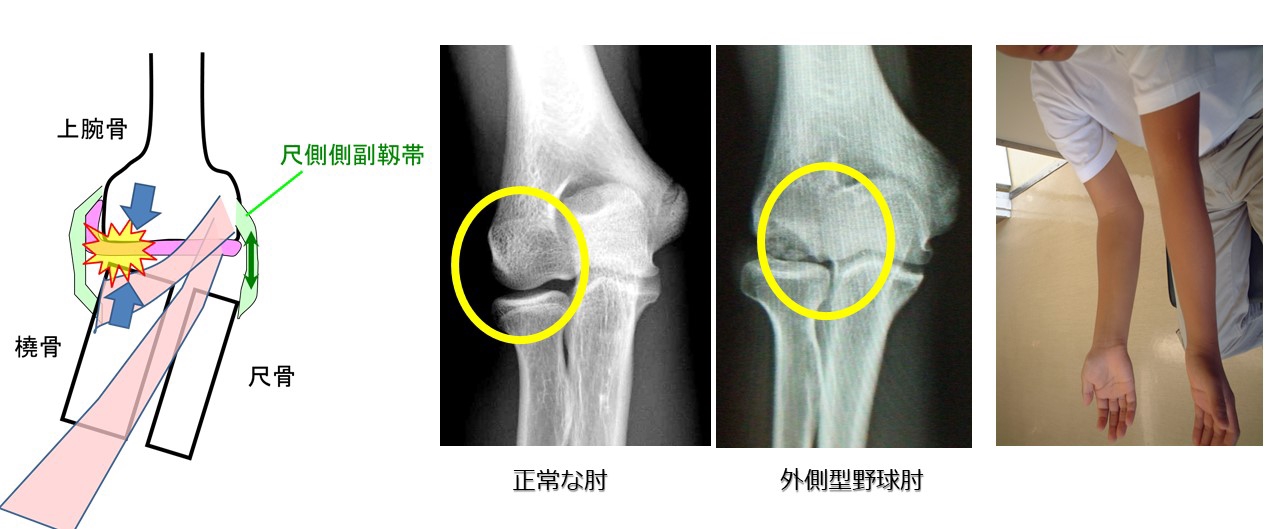 外側型野球肘（離断性骨軟骨炎） | 野球肘 スポーツ肘を治す