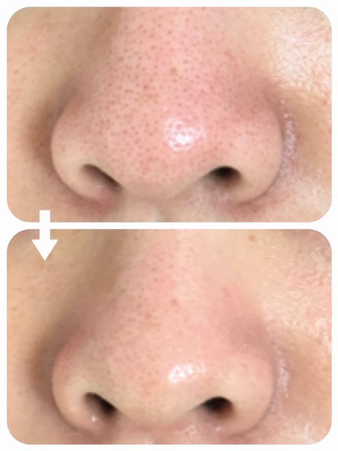 あきらめていた悩みの 毛穴のトラブル フェイシャルエステ M S Room