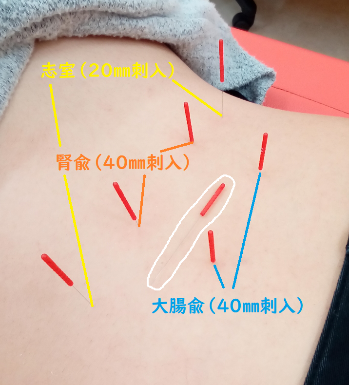 刺入部とは, ドレーン刺入部 – KFSWCU