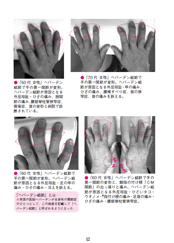 大好評発売中 あなたの指先 変形していませんか 指先が変形して痛い へバーデン結節 の予防と治し方 一部原稿を読めます 自由国民社フリーリーディングスペース