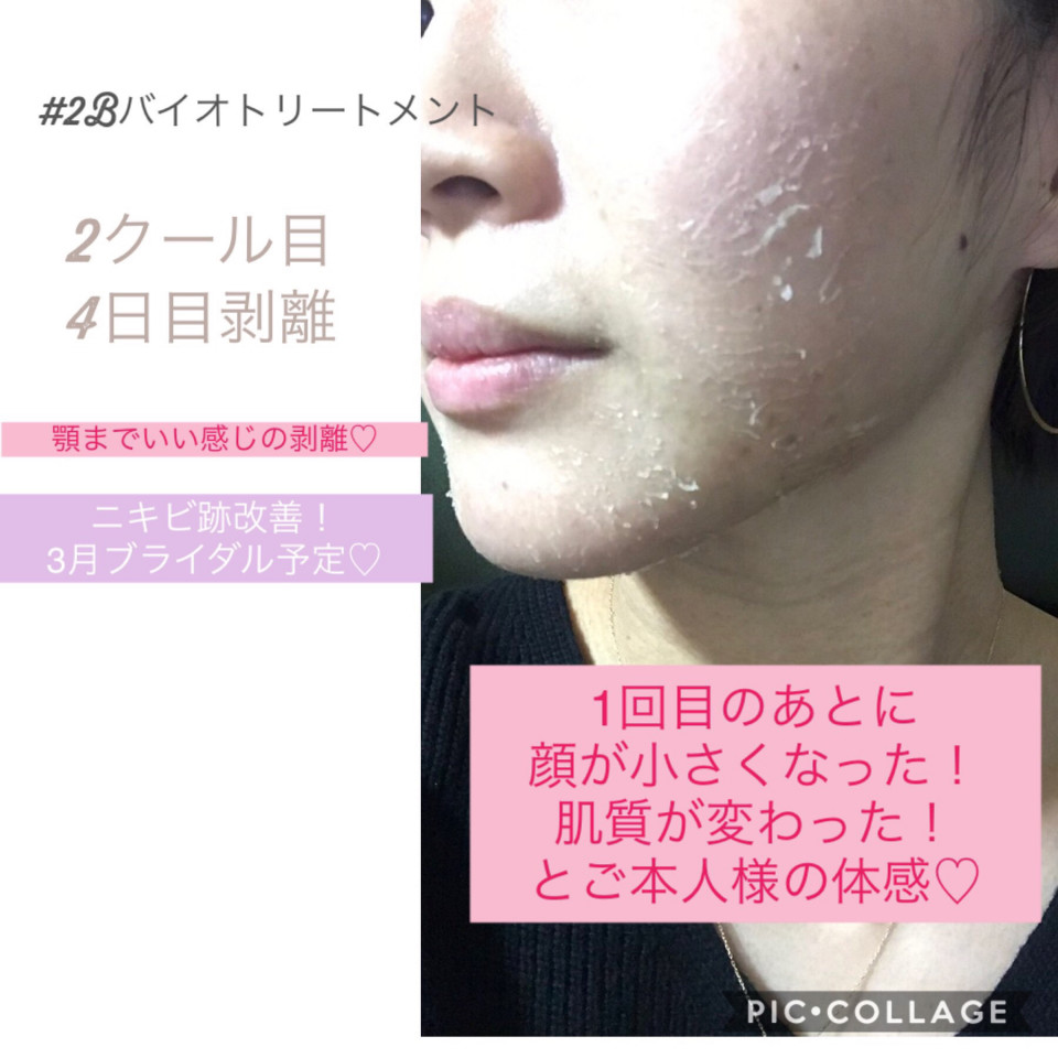 バイオプランタ 2Bバイオトリートメント8包 義務付け