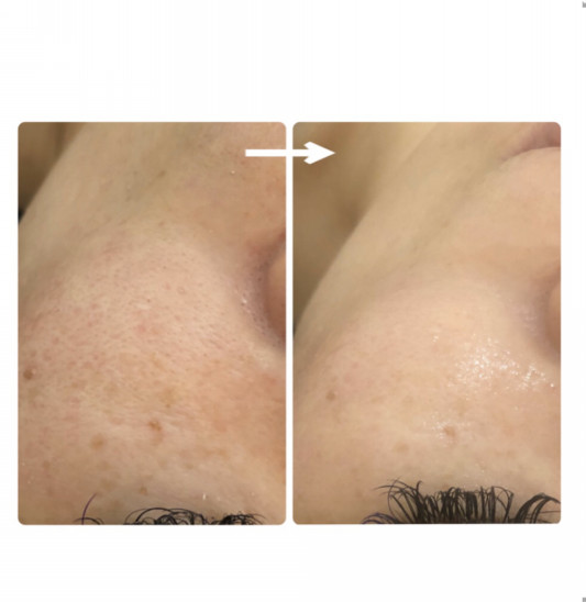 針のいらない炭酸ガスパック Beauty Salon Citron