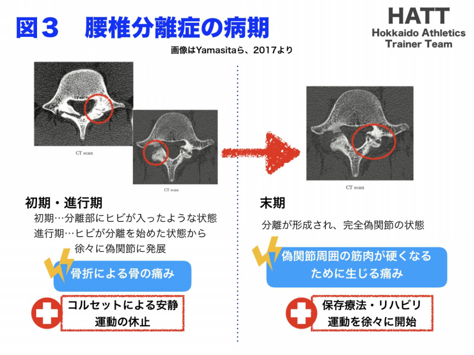 傷害予防シリーズ4 腰椎分離症 Hatt 北海道陸上競技トレーナーチーム