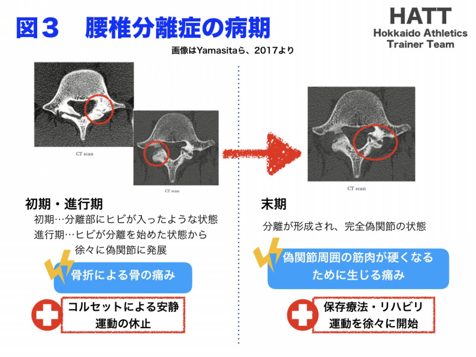 症 腰椎 筋 トレ すべり