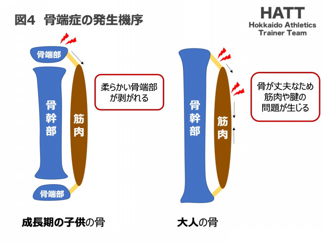 傷害予防シリーズ 7 骨端症 Hatt 北海道陸上競技トレーナーチーム