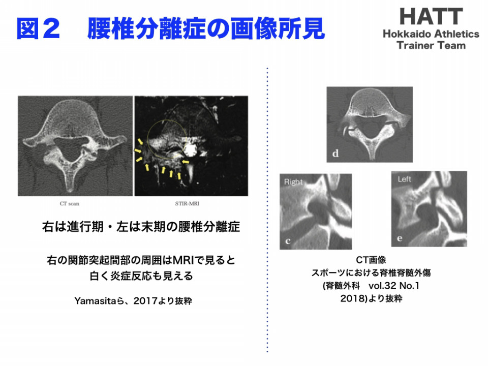 傷害予防シリーズ4 腰椎分離症 Hatt 北海道陸上競技トレーナーチーム