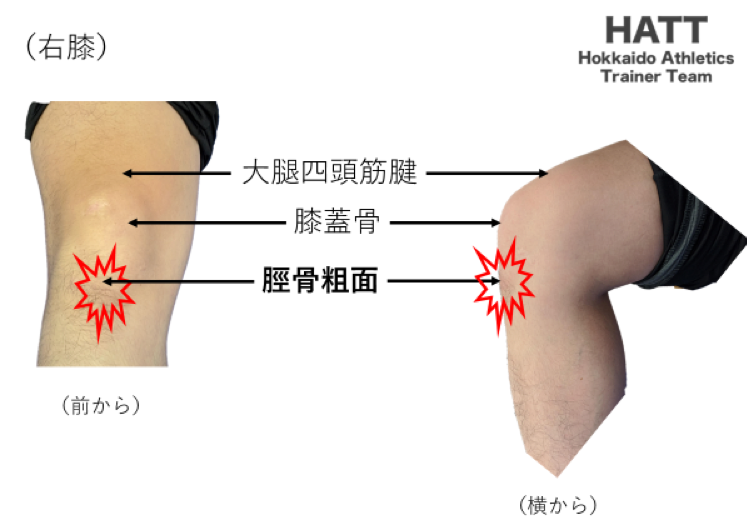 障害予防シリーズ6 オスグッド シュラッター病 Hatt 北海道陸上競技トレーナーチーム