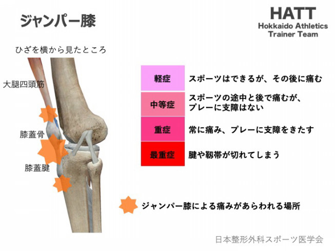 傷害予防シリーズ9 ジャンパー膝 Hatt 北海道陸上競技トレーナーチーム