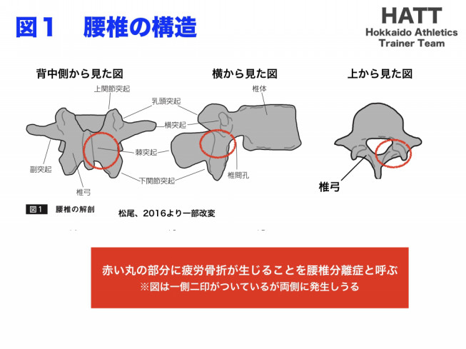 傷害予防シリーズ4 腰椎分離症 Hatt 北海道陸上競技トレーナーチーム