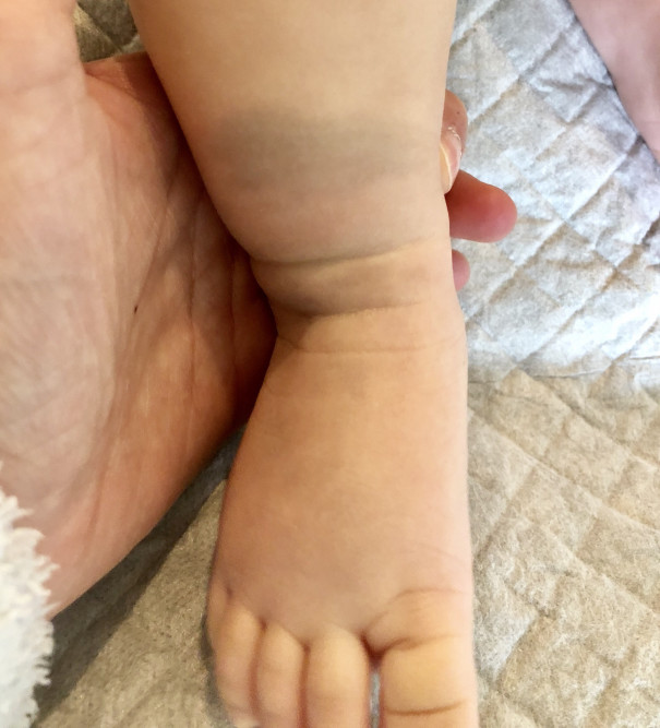 異所性蒙古斑 レーザー治療しました F M A Inui Ayumi