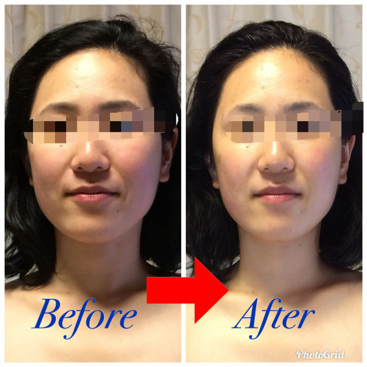 痛くない小顔矯正始めました Private Salon Aquange