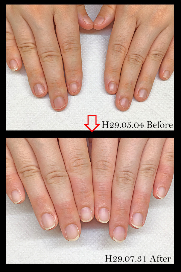 結果の出る深爪矯正 深爪矯正 自爪育成メディカル ネイルサロン ベアトラ Veatlla