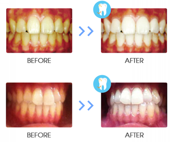 セルフホワイトニング   すぐに始められます。 セルフホワイトニング すぐに始められます。 セルフホワイトニング