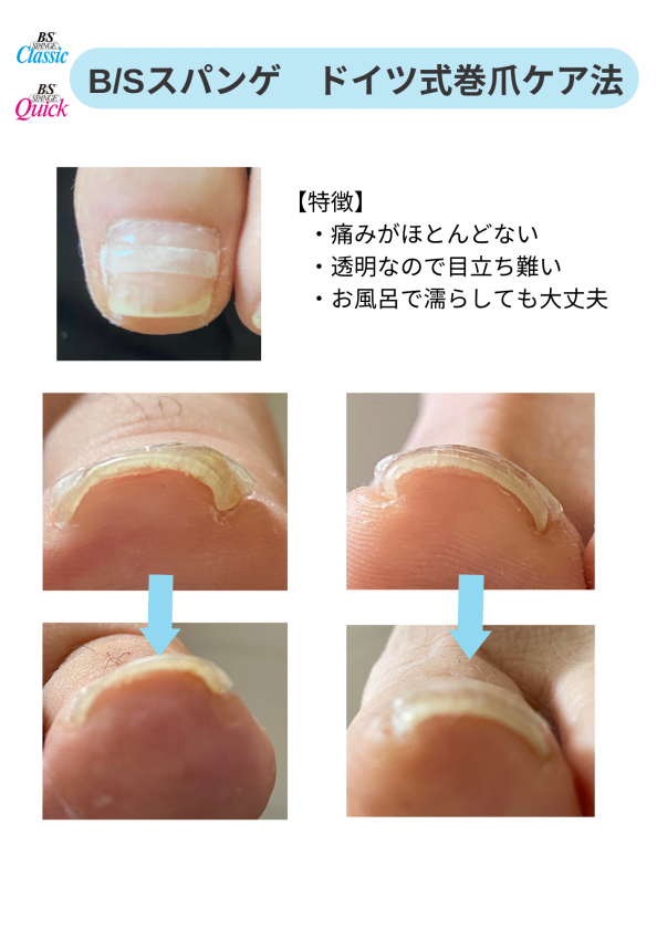 ドイツ式巻爪ケア法「B/Sスパンゲ」モニター様募集 | 仙台足の爪切り