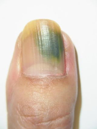 爪の病気 グリーンネイルにご注意ください 佐世保市ネイルサロン 爪が傷まず上品なネイルのキヨノネイル