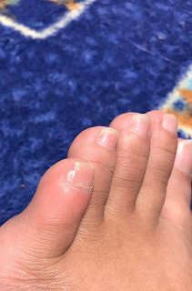 フットケア 足の小指がストッキングや靴下にひっかかる方へ 佐世保 フットケア 足の小指がストッキングや靴下にひっかかる方へ 佐世保