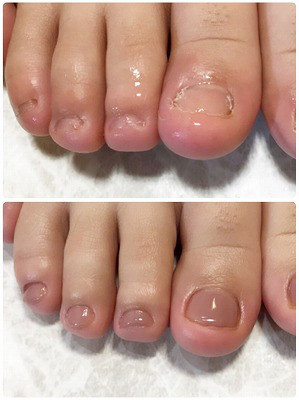 足の深爪ケア キレイに伸びてきました 佐世保市ネイルサロン 爪が傷まず上品なネイルのキヨノネイル