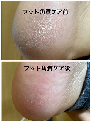 足のかかとのガサガサが気になる方限定メニュー 佐世保市ネイルサロン 爪が傷まず上品なネイルのキヨノネイル 足のかかとのガサガサが気になる方限定メニュー 佐世保市ネイルサロン 爪が傷まず上品なネイルのキヨノネイル