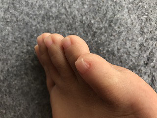 フットケア 足の小指がストッキングや靴下にひっかかる方へ 佐世保市ネイルサロン 爪が傷まず上品なネイルのキヨノネイル