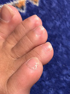 フットケア 足の小指がストッキングや靴下にひっかかる方へ 佐世保市ネイルサロン 爪が傷まず上品なネイルのキヨノネイル