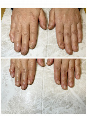 深爪矯正 爪と指先の皮膚をむしるのがやめられない 佐世保市ネイルサロン 爪が傷まず上品なネイルのキヨノネイル