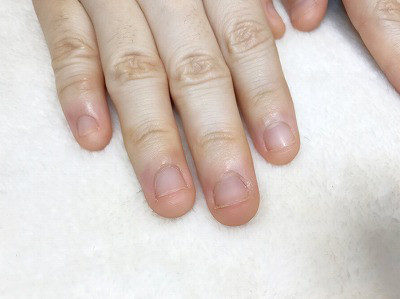 深爪矯正 私でもキレイな爪になりますか 佐世保市ネイルサロン 爪が傷まず上品なネイルのキヨノネイル