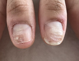 お爪のでこぼこでお悩みのお客様のお爪の変化 約2ヶ月2週目 佐世保市ネイルサロン 爪が傷まず上品なネイルのキヨノネイル