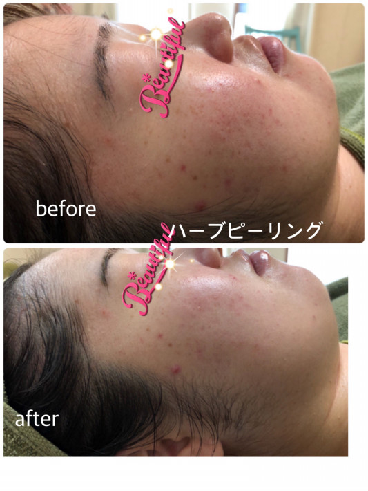 11月空き状況です 沼津 三島 長泉 大人ニキビ シミ くすみに ハーブピーリングで肌再生 Prairie プレイリー