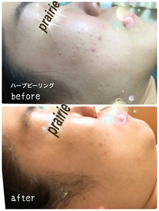 ハーブピーリングで成人式エステ 沼津 三島 長泉 大人ニキビ シミ くすみに ハーブピーリングで肌再生 Prairie プレイリー